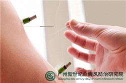 过敏性白斑是不是白癜风